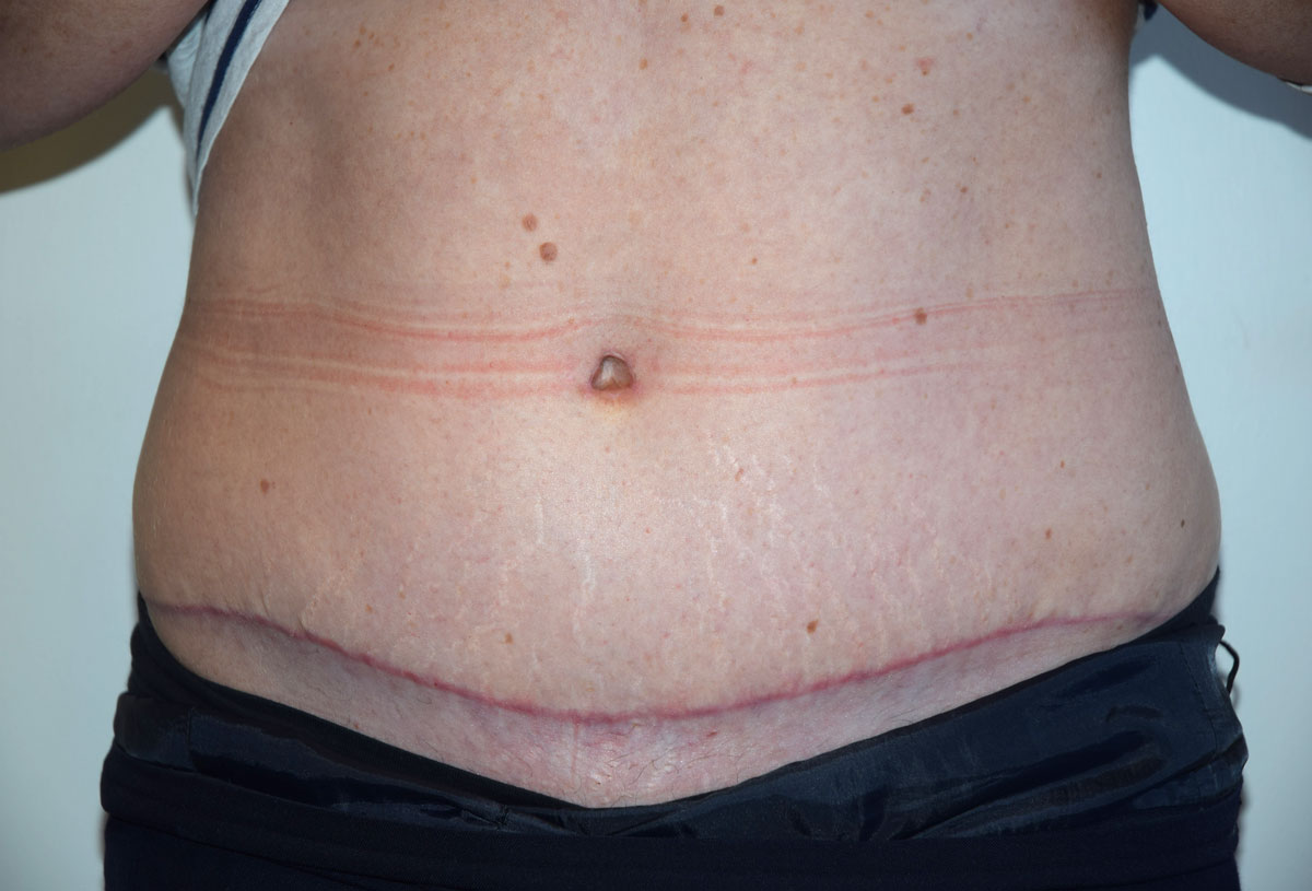 pictures swelling after tummy tuck